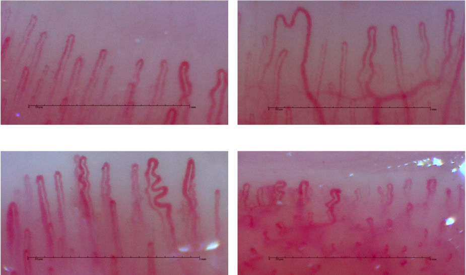 指の毛細血管画像